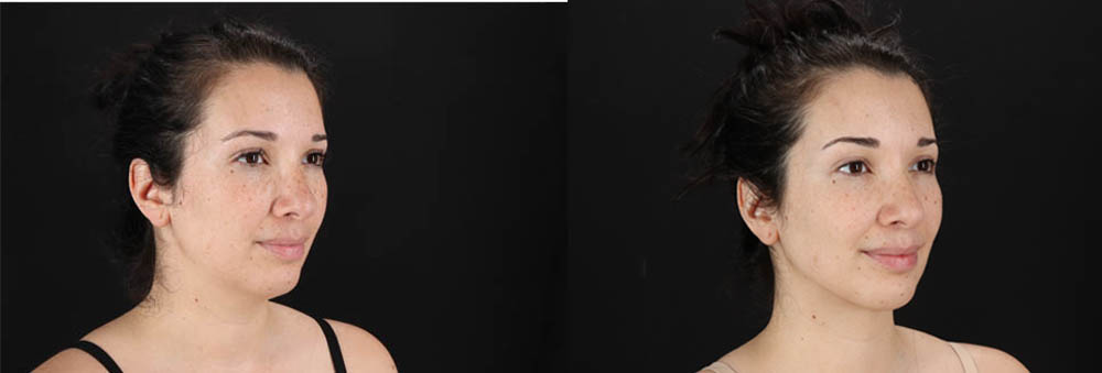 Submental Liposuction case #257416