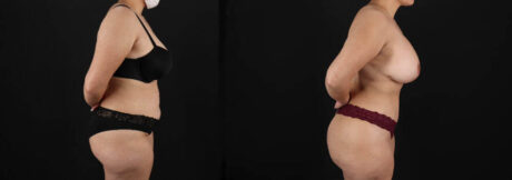 Tummy Tuck case #7618