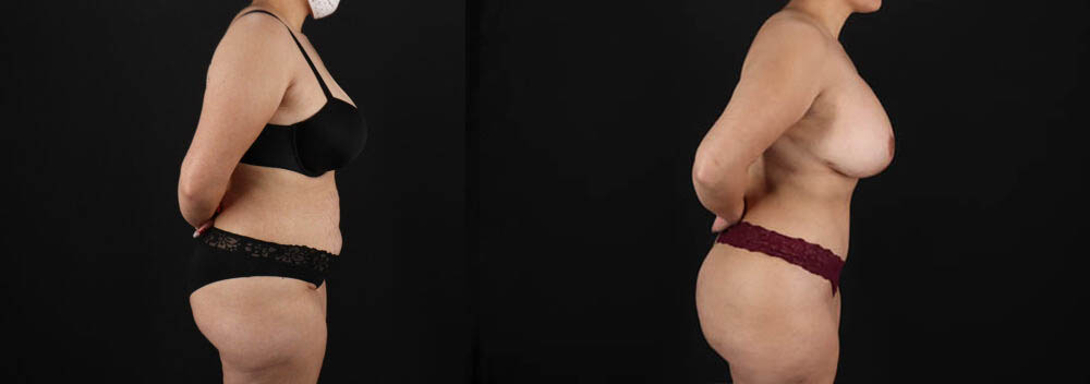 Tummy Tuck case #7618