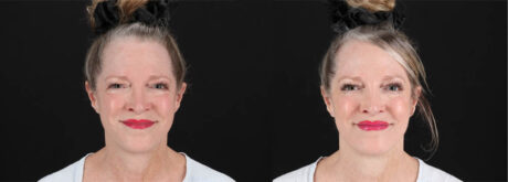 Botox® & Other Neuromodulators case #257429