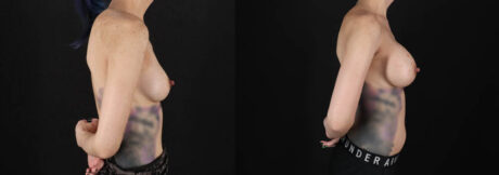 Breast Augmentation case #6444