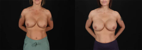 Revision Breast Surgery case #257422