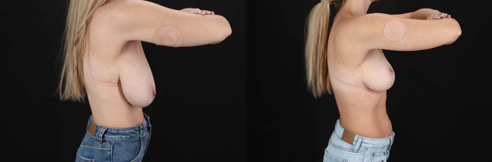 Breast Lift case #7826