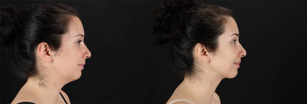 Submental Liposuction case #257416