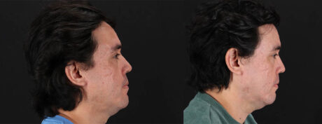 Co2 Laser case #256595