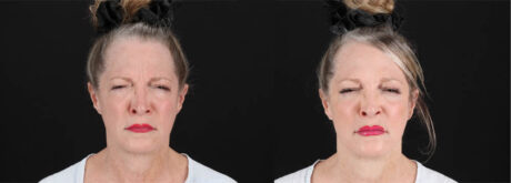 Botox® & Other Neuromodulators case #257429