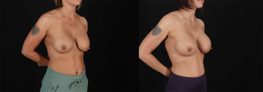 Revision Breast Surgery case #257422