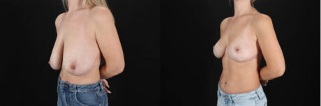 Breast Lift case #7826