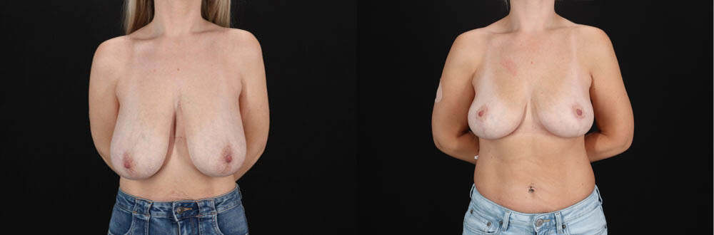 Breast Lift case #7826