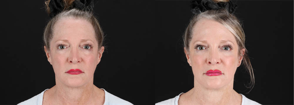 Botox® & Other Neuromodulators case #257429