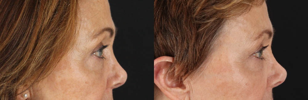 Blepharoplasty case #6889