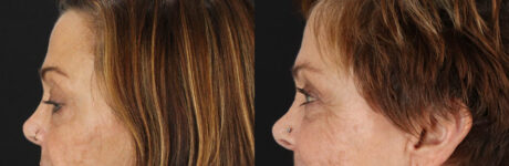 Blepharoplasty case #6889