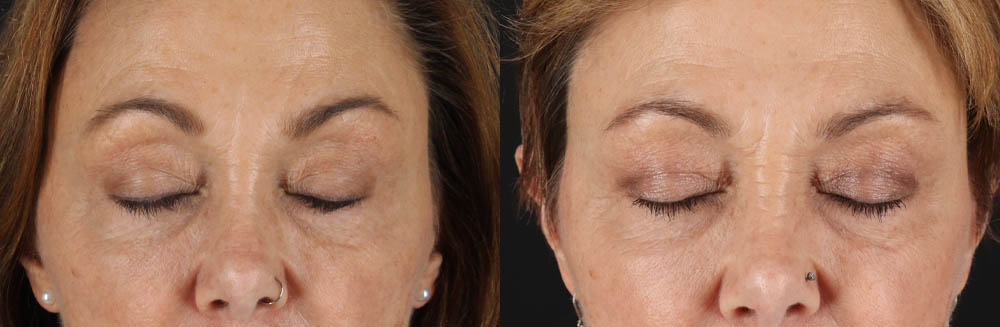 Blepharoplasty case #6889