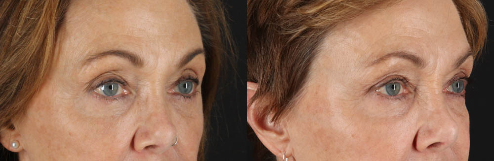 Blepharoplasty case #6889