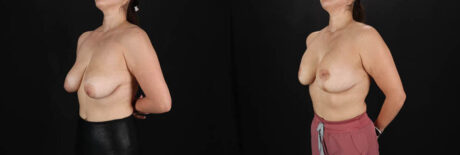 Breast Lift with Implants case #256828