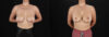 Breast Lift with Implants case #256828 slider thumbnail