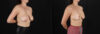 Breast Lift with Implants case #256828 slider thumbnail