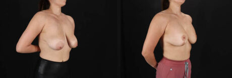 Breast Lift with Implants case #256828