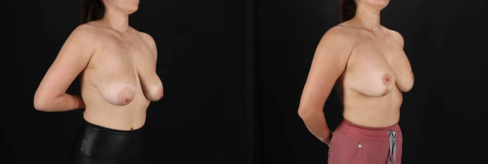 Breast Lift with Implants case #256828