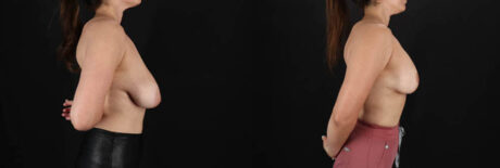 Breast Lift with Implants case #256828