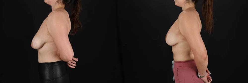 Breast Lift with Implants case #256828