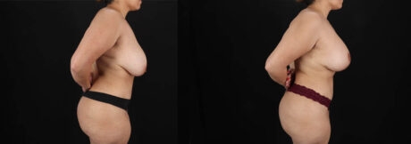 Revision Breast Surgery case #256503
