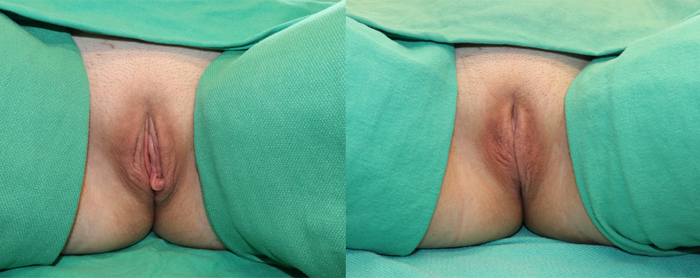 Labiaplasty case #257468
