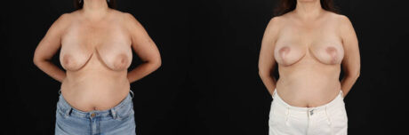 Breast Lift case #256822