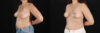 Breast Lift case #256822 slider thumbnail