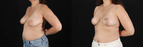 Breast Lift case #256822