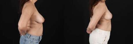 Breast Lift case #256822