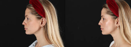 Skin Pen Microneedling case #258899