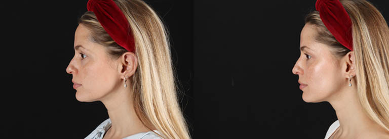 Skin Pen Microneedling case #258899