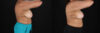 Breast Reduction case #258846 slider thumbnail