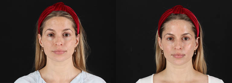 Skin Pen Microneedling case #258899