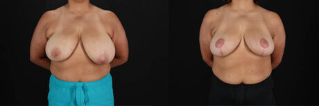 Breast Reduction case #258846