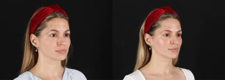 Skin Pen Microneedling case #258899