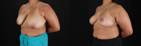 Breast Reduction case #258846