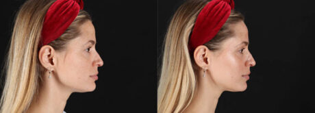 Skin Pen Microneedling case #258899