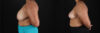 Breast Reduction case #258846 slider thumbnail