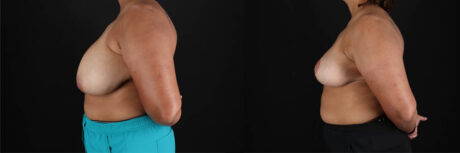 Breast Reduction case #258846