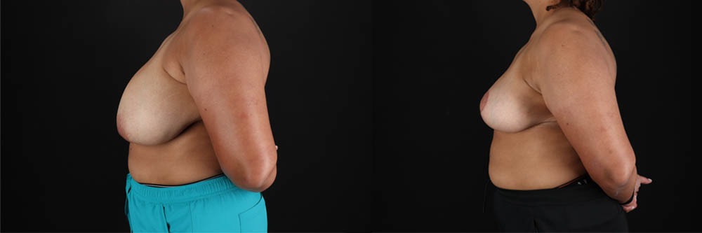 Breast Reduction case #258846