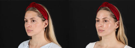 Skin Pen Microneedling case #258899