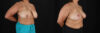 Breast Reduction case #258846 slider thumbnail