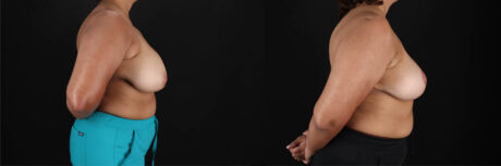 Breast Reduction case #258846