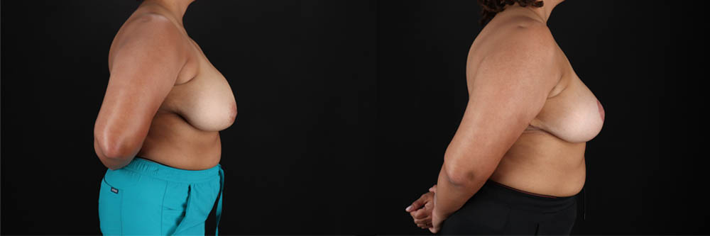 Breast Reduction case #258846
