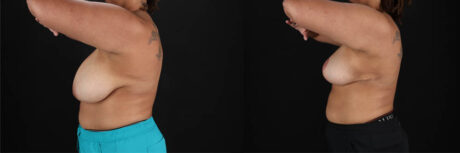 Breast Reduction case #258846