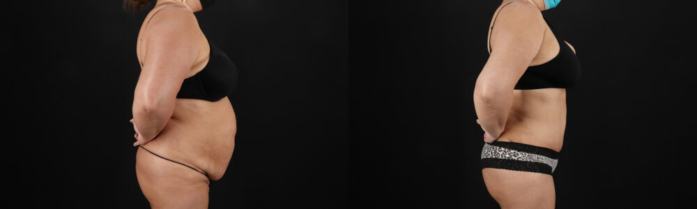 Tummy Tuck case #259095