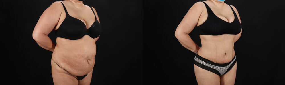 Tummy Tuck case #259095