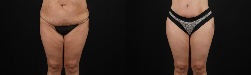 Tummy Tuck case #259095